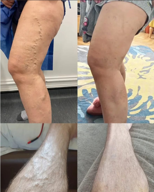 PACK SPRAY VENAS VARICOSAS + 40 PARCHES ANTI VÁRICES